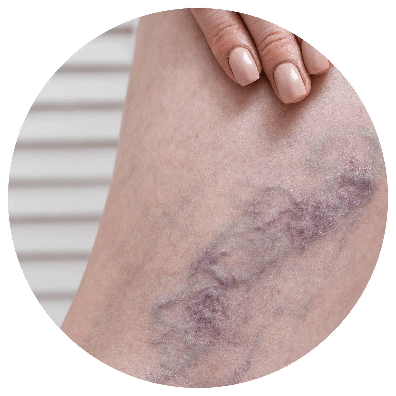 Spider Veins treatment process at Toronto medical spa - Understand what your skin is trying to tell you.